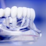 Implanty dentystyczne – zalety i wady